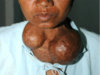 thyroid-goiter-740.jpg